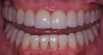 Five-year postoperative follow-up retracted photograph with teeth apart.