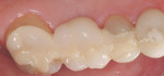 Figure 13  The intraoral occlusal view of the FPD demonstrates excellent shade match.