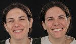 Fig 8. Motivational mock-up with projected smile design on the right.