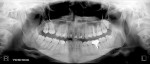 Fig 3. Preoperative panoramic radiograph revealing tooth crowding and several failing restorations.