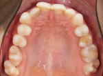 Fig 4 and Fig 5. Preoperative intraoral occlusal views of the maxillary (Fig 4) and mandibular (Fig 5) arches.