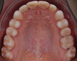 Fig 6 and Fig 7. Intraoral occlusal views of the maxillary (Fig 6) and mandibular (Fig 7) arches after tooth extractions and orthodontic treatment.