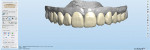 Fig 9. Tooth shapes were selected from a library for the digital wax-up and setup based on the patient’s facial features and esthetic expectations.