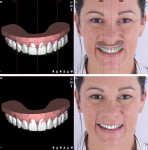 Fig 1. Ideal smile design. Tooth proportions are determined based on a smile frame. An ideal smile is simulated by superimposing the digital wax-up to the patient’s photography.