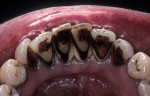 Figure 4a&ensp; Periodontally compromised mandibular incisors treatment planned for splinting with an adhesive fiber-reinforced composite resin.
