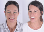 Fig 3. Clinical proof of motivational mock-up. Comparison between initial smile (left) and ideal smile determined by the mock-up (right).