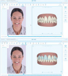Fig 4. Orthodontic virtual planning software showing face before (above) and after orthodontic movements (below) for maxillary expansion. Teeth vestibular faces in blue represent the simulated restorations.