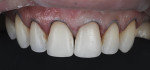 Fig 5. Minimally invasive tooth preparation for anterior restorations.