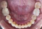 Fig 7 through Fig 9. At 8 years after the start of treatment: patient’s oral condition, frontal view (Fig 7); maxillary arch, occlusal view (Fig 8); mandibular arch, occlusal view (Fig 9).