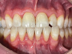 Fig 7 through Fig 9. At 8 years after the start of treatment: patient’s oral condition, frontal view (Fig 7); maxillary arch, occlusal view (Fig 8); mandibular arch, occlusal view (Fig 9).