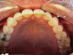 Fig 12. Initial condition showing poor interproximal spacing, especially distal of tooth No. 23.