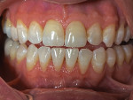 Fig 13. Previous full-mouth radiographs before clear aligner treatment.