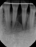 Fig 1. Case 1, preoperative radiograph. Note radiolucency on mesial of tooth No. 24.