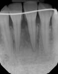 Fig 2. Case 1, 1-year postoperative radiograph. Note good bone fill at the bone defect.