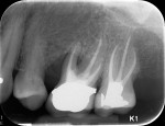 Fig 3. Case 2, preoperative radiograph. Note deep vertical bone defect and mesial furcation involvement, tooth No. 14.
