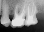 Fig 4. Case 2, 4-month postoperative radiograph. Note good bone fill at the prior defect.