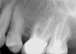 Fig 5. Case 2, 1.5-year postoperative radiograph. Note stability of regenerated bone.