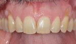 Fig 6. Case 3, preoperative photograph. Note significant recession on teeth Nos. 6 and 11.
