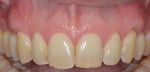 Fig 7. Case 3, 8-week postoperative photograph. Note improved situation at teeth Nos. 6 and 11.