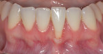 Fig 8. Case 4, preoperative photograph, frontal view. Note recession on tooth No. 24.