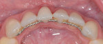 Fig 9. Case 4, preoperative photograph, occlusal view. Note misalignment of tooth No. 24.
