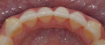 Fig 10. Case 4, preoperative photograph after clear aligner treatment, occlusal view.