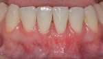 Fig 12. Case 4, 8-week postoperative photograph. Note complete root coverage at tooth No. 24.