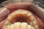 Fig 1. Primary maxillary canines to act as socket shields for two immediate dental implants, occlusal view.