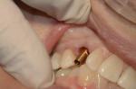 Fig 6 through Fig 8. Stock abutment.