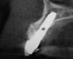 Fig 9. In CBCT note primary tooth and pulp chamber.