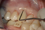 Fig 13. Removal of excess composite.