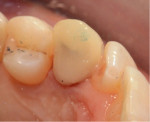 Fig 16. Palatal view of provisional crown.