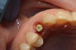 Fig 17. Early 3-month healing of shield area; veneer on lateral incisor.