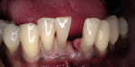 Figure 5c&ensp; Facial view after extraction of the central incisor.