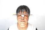 Fig 3. Facial reference glasses were used to determine the patient’s natural head position. Note the bubble level on the patient’s right side of the glasses.