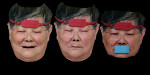 Fig 7. The facial scanner was used to record three 3D facial scans with the forehead scanbody and mouth scanbody. The technician can use the forehead scanbody to merge the three images together.