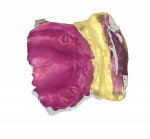 Fig 9. The STL file of the mouth scanbody, upper arch. The technician can use the forehead scan and the mouth scan to locate the position of the maxilla and the mandible.