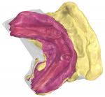 Fig 10. The STL file of the mouth scanbody, lower arch.