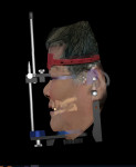 Fig 11 through Fig 13. Integration of the facial and intraoral scans into CAD software, yielding high precision. Both the front of the patient and the intraoral situation will be visible on the screen, allowing the virtual articulator to be used and the prosthetic piece to demonstrate function.