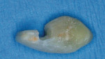 Figure 5e&ensp; Natural tooth pontic after filling in root canal space, shaping the root surface to be the pontic, and placing the lingual channel in the tooth crown.