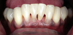 Figure 5g  Facial view of fiber-reinforced  splint-bridge at 6 months.