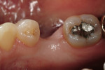 Figure 6a&ensp; Missing mandibular premolar; the patient has declined the placement and restoration of missing tooth with an implant. The clinical decision was for a fiber FPD.