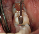 Figure 6b&ensp; Sizing instrument to prepare the proximal box to an adequate width for the Tescera quartz fiber U-Beam.