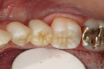 Figure 7  The completed 3-unit fiber-rein-forced resin FPD replacing the mandibular second premolar.