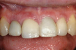 Figure 1a  This 48-year-old woman wanted to improve the esthetic appearance of her maxillary anterior teeth. All four maxillary incisors had been restored previously.