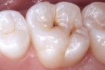Pretreatment photograph of a molar exhibiting deep occlusal caries.
