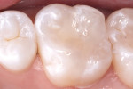 Posttreatment occlusal view of the completed Class I restoration.