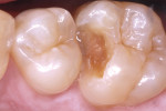 Occlusal photograph of Class II preparation with deep excavation in close proximity to the pulp.