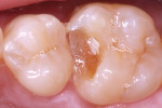 A resin-modified calcium silicate material was placed as a protective liner and light cured.