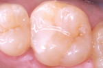 Posttreatment occlusal view of the completed Class II restoration.
